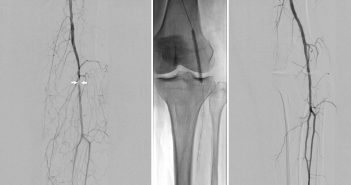 Neuartige Stoßwellentherapie hilft bei stark verkalkten, verengten Beingefäßen