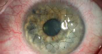 Infoveranstaltung: Gesunde Augen – was kann ich selbst dafür tun?